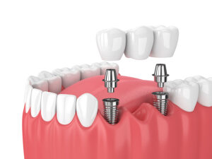 implant dentistry near me,