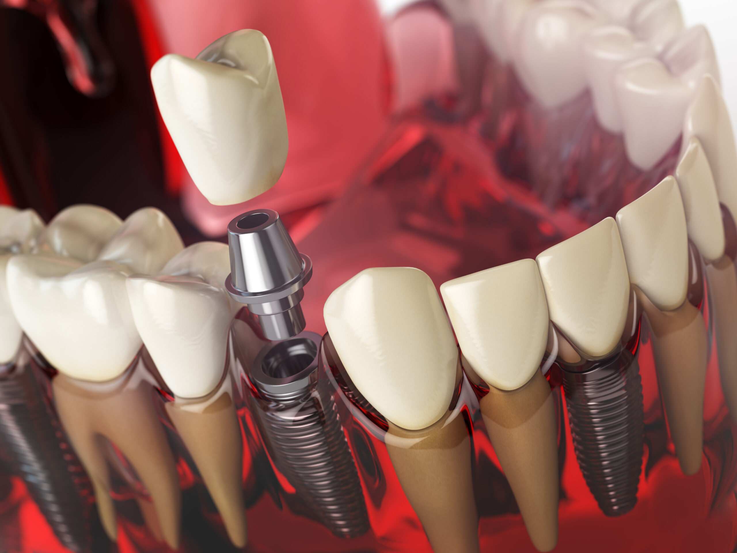 home care after dental implant surgery