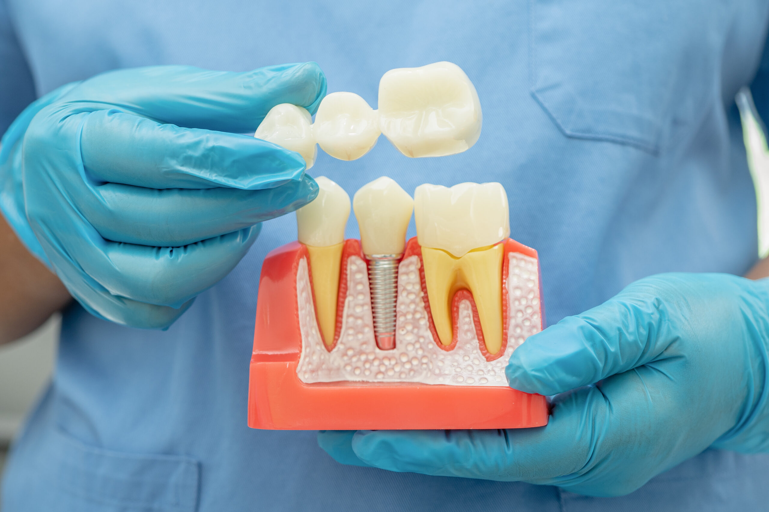 bridge vs dental implant​